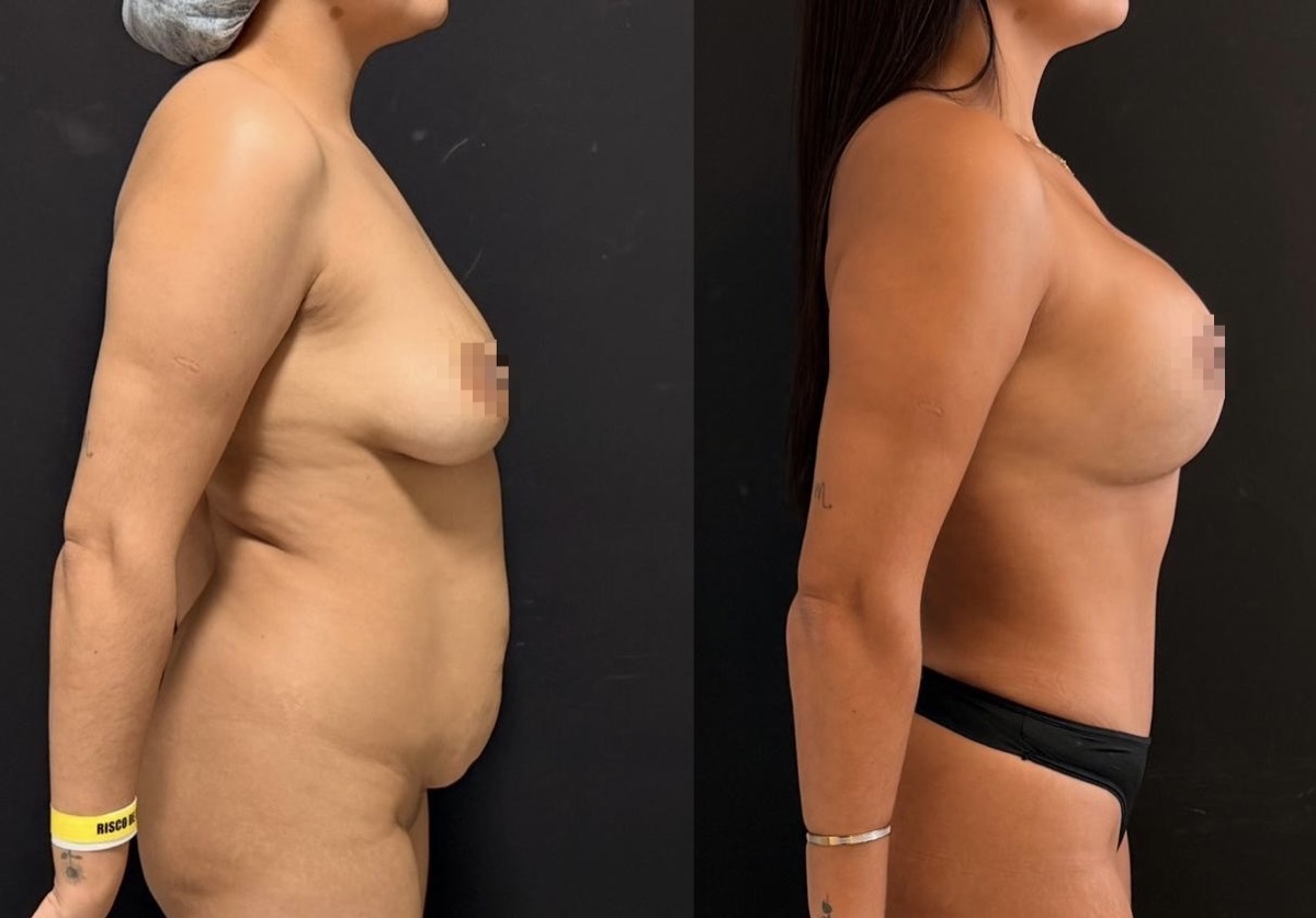Antes e depois — cirurgia plástica Dr. Deivis Albers