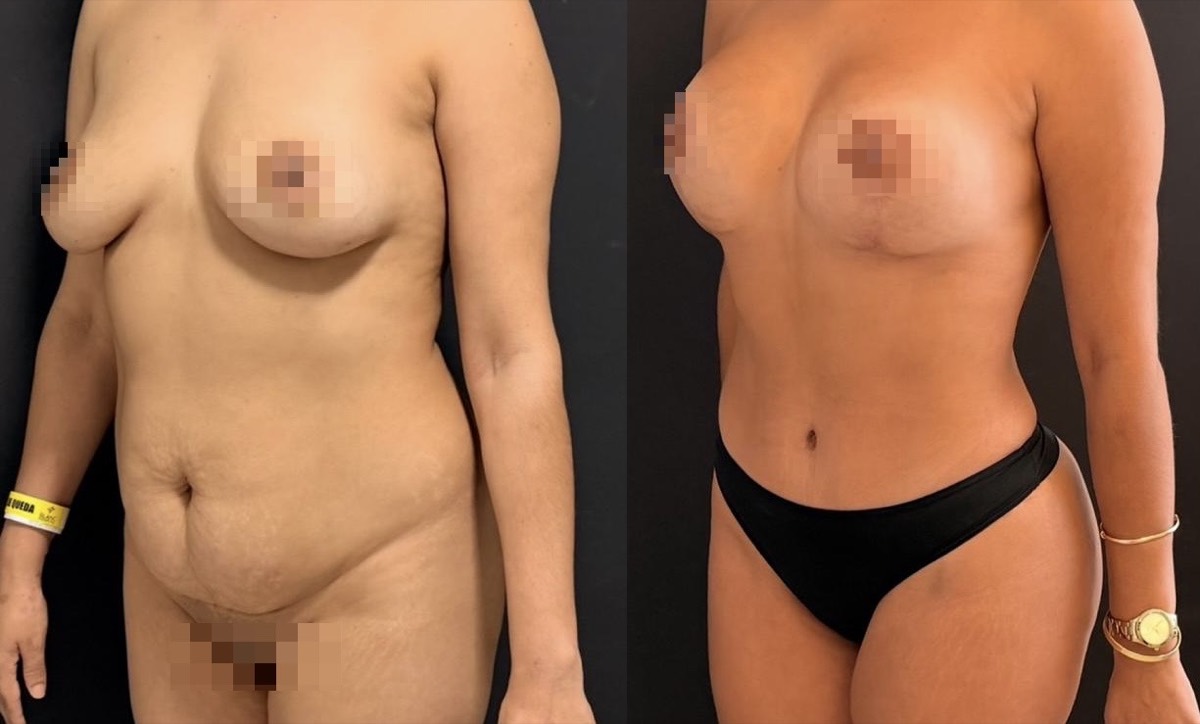 Antes e depois — cirurgia plástica Dr. Deivis Albers