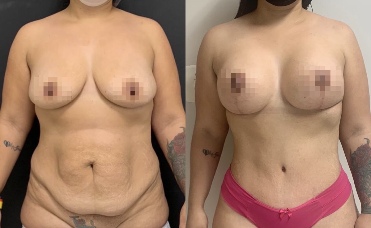 Antes e depois — cirurgia plástica Dr. Deivis Albers