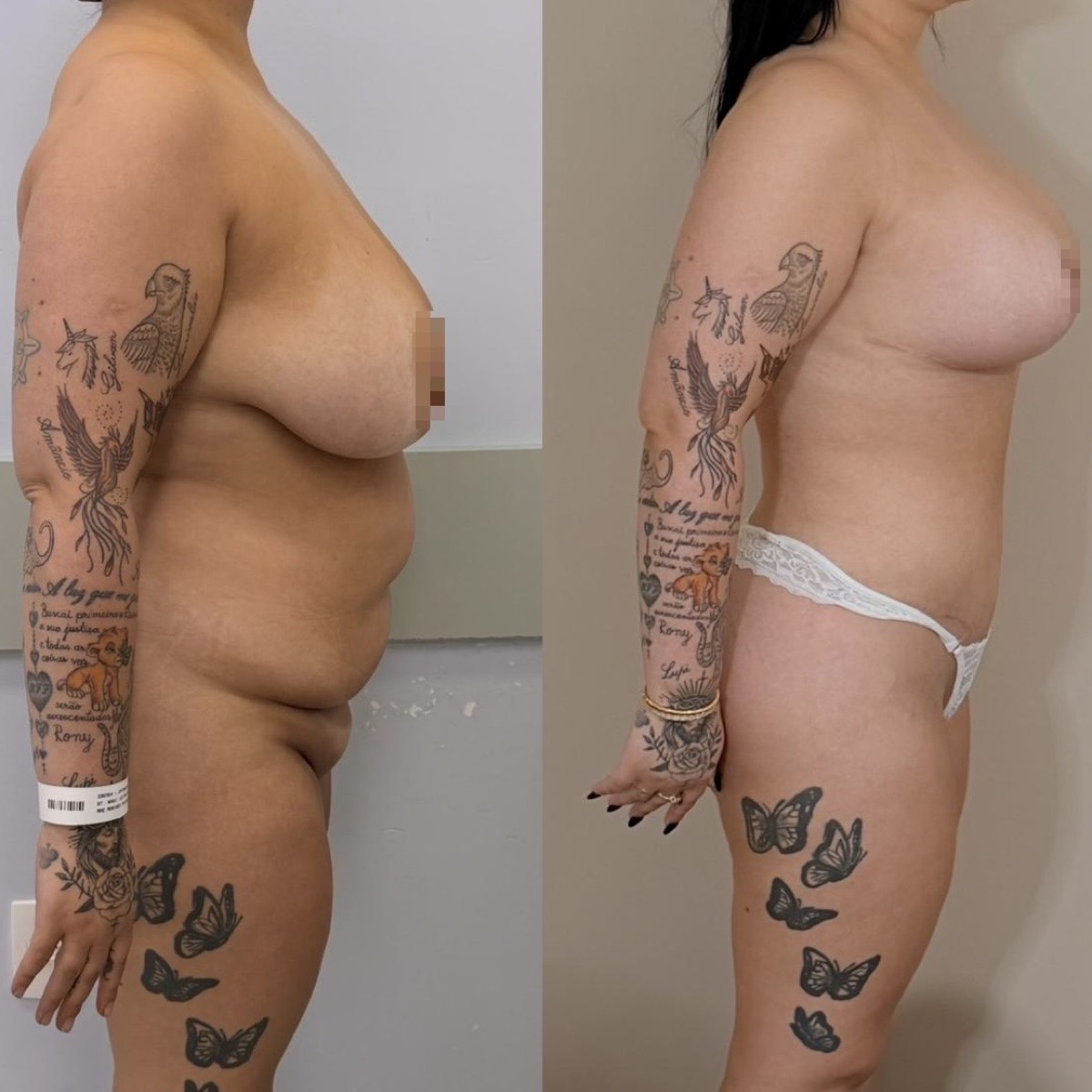 Antes e depois — cirurgia plástica Dr. Deivis Albers