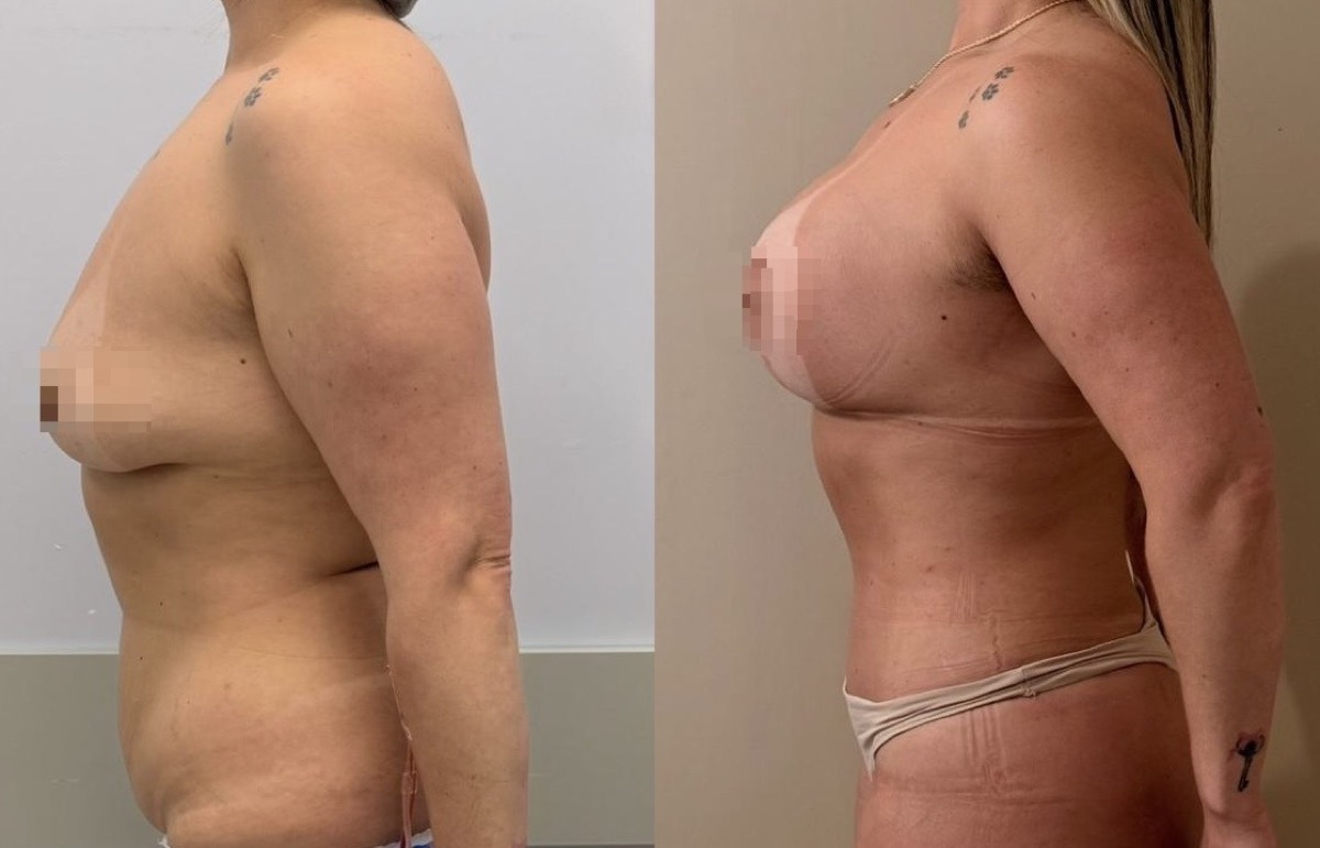 Antes e depois — cirurgia plástica Dr. Deivis Albers