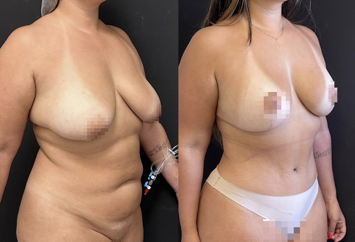 Antes e depois — cirurgia plástica Dr. Deivis Albers