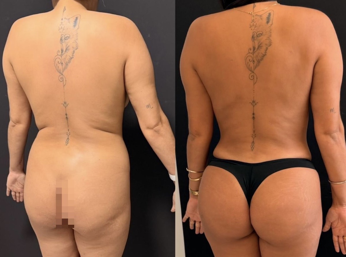 Antes e depois — cirurgia plástica Dr. Deivis Albers