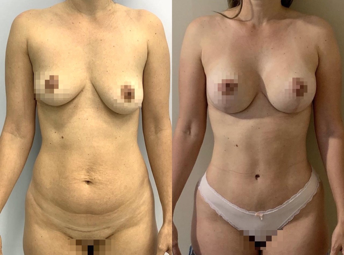 Antes e depois — cirurgia plástica Dr. Deivis Albers